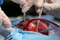 ۳۲ بیمار کلیویی در گیلان در انتظار پیوند